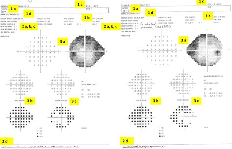 automated perimetry test results interpretation|Visual Field Test: What It Is and What the Results .